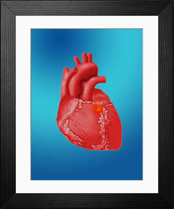 Framed Print : Heart Attack, Conceptual Illustration Framed Print : Heart Attack, Conceptual Illustration