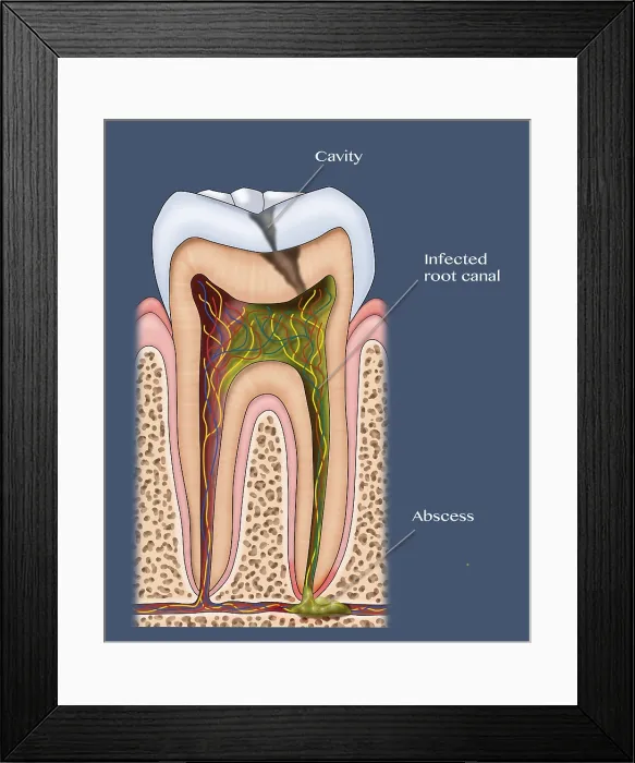 Framed Print : Dental Cavity and Abscess, tooth cross section of enamel, pulp, medical Illustration Framed Print : Dental Cavity and Abscess, tooth cross section of enamel, pulp, medical Illustration