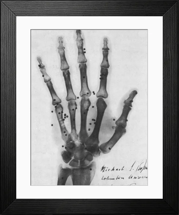 Framed Print : X-ray of Gunshot in the Hand, 1896 Framed Print : X-ray of Gunshot in the Hand, 1896