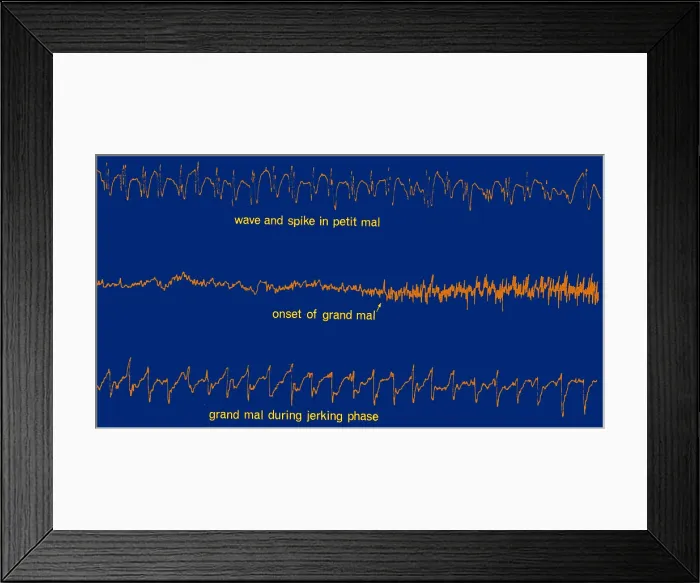 Framed Print : EEG of Epileptic Seizures Framed Print : EEG of Epileptic Seizures