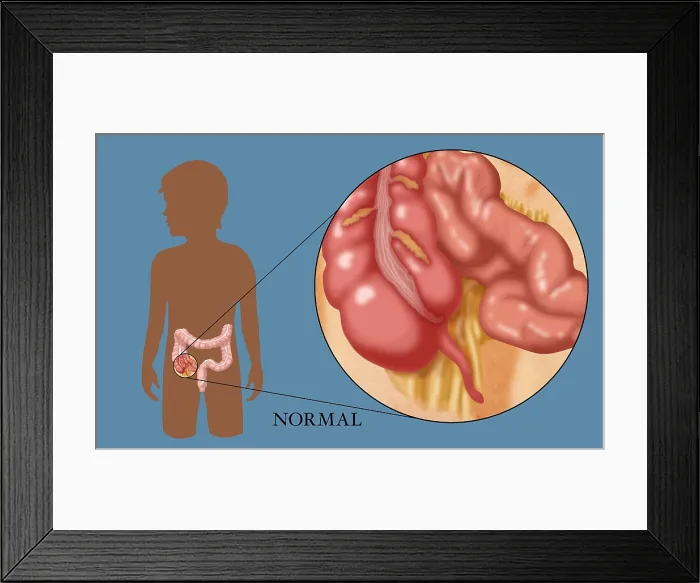 Framed Print : Normal Appendix Framed Print : Normal Appendix