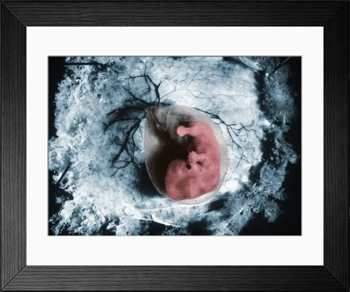 Framed Print : Human Embryo, gross specimen Framed Print : Human Embryo, gross specimen