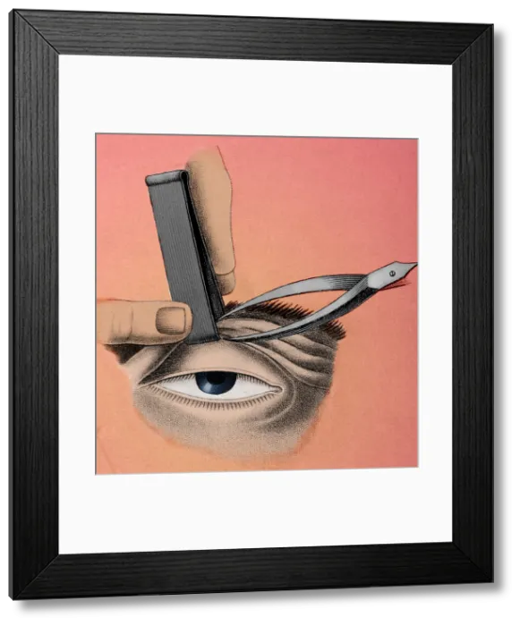 Framed Print : Surgery to Correct Lazy Eyelid, 1830 Framed Print : Surgery to Correct Lazy Eyelid, 1830