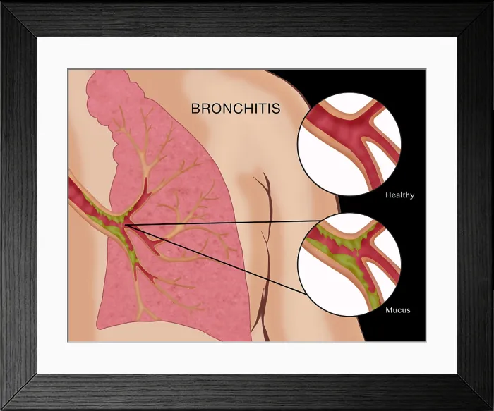 Framed Print : Bronchitis Framed Print : Bronchitis