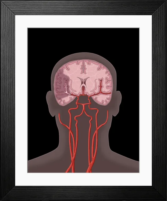 Framed Print : Ischemic Stroke, Illustration