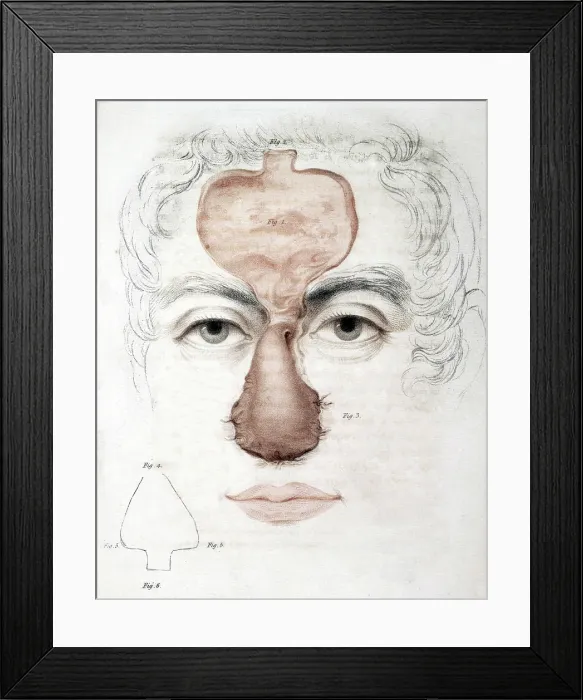 Framed Print : Nose Reconstruction, 1815 Medical Text