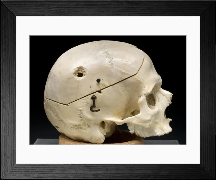 Framed Print : Gunshot Trauma to Skull, 1950's Framed Print : Gunshot Trauma to Skull, 1950's