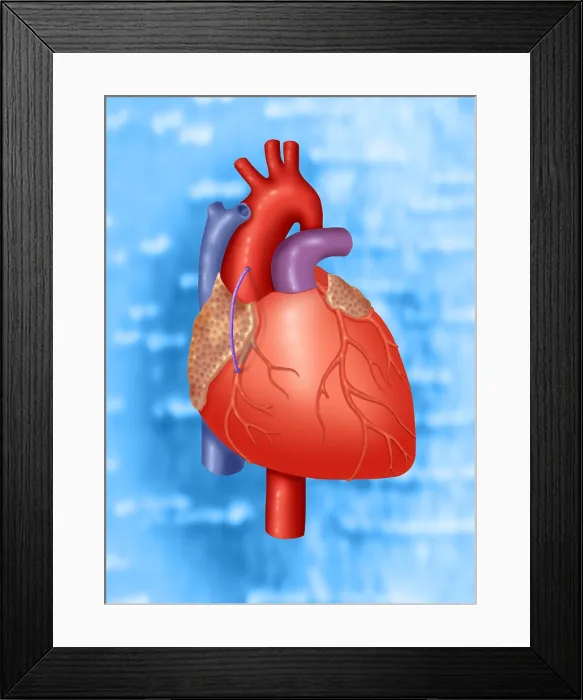 Framed Print : Coronary Vein Graft Framed Print : Coronary Vein Graft