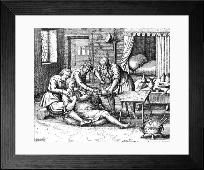Framed Print : Gangrene Amputation of Leg, 17th Century Framed Print : Gangrene Amputation of Leg, 17th Century