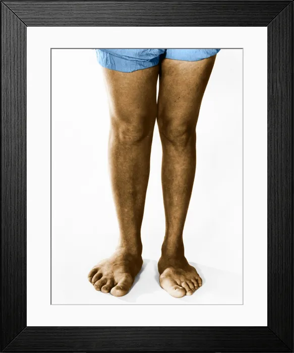 Framed Print : Gigantism. Color enhanced photo of a patient with gigantism of the feet Framed Print : Gigantism. Color enhanced photo of a patient with gigantism of the feet
