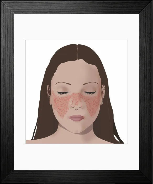 Framed Print : Lupus or systemic lupus erythematosus (SLE) butterfly shaped rash on woman's face, nose and cheeks, illustration Framed Print : Lupus or systemic lupus erythematosus (SLE) butterfly shaped rash on woman's face, nose and cheeks, illustration