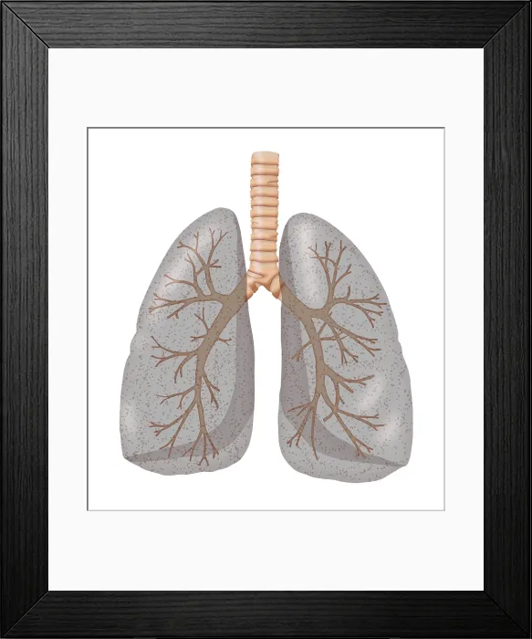 Framed Print : Smoker's Lungs Framed Print : Smoker's Lungs