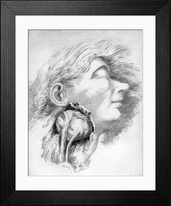 Framed Print : Aneurysm of the Carotid Artery