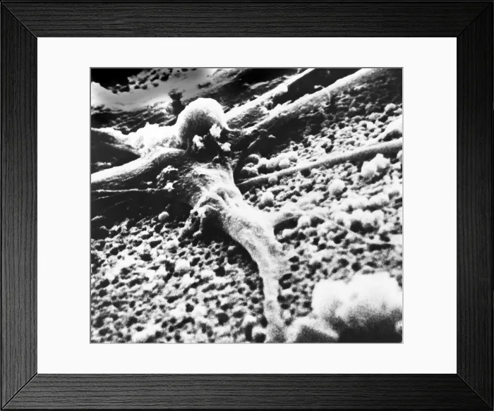 Framed Print : Malignant cancer cell Framed Print : Malignant cancer cell