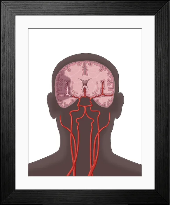 Framed Print : Ischemic Stroke, Illustration