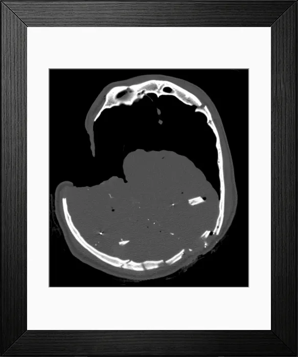 Framed Print : CT Section, Gunshot Wound