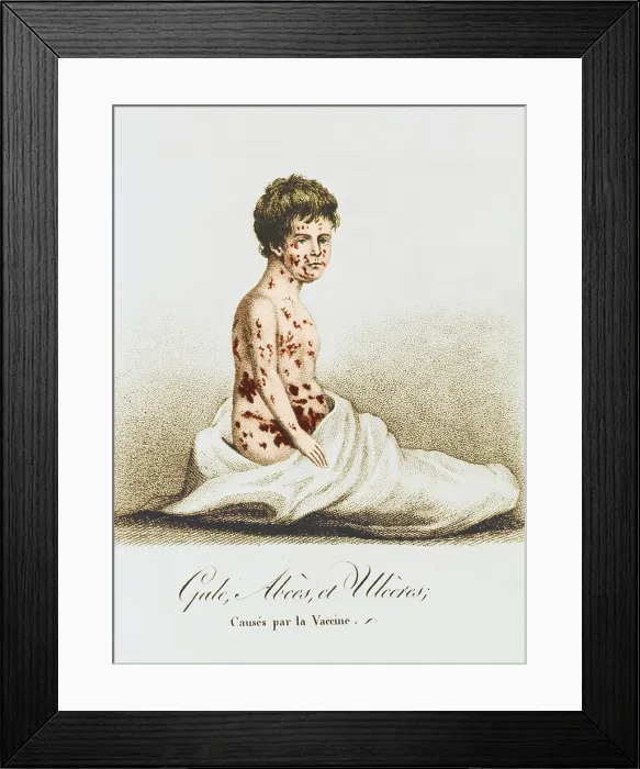 Framed Print : Development of Smallpox after Vaccination, 1807 Framed Print : Development of Smallpox after Vaccination, 1807