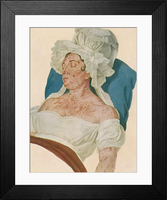 Framed Print : Scarlet Fever Framed Print : Scarlet Fever