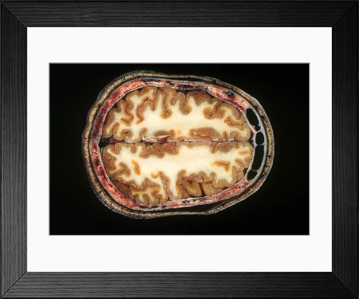 Framed Print : Slice of Human Brain, gross specimen Framed Print : Slice of Human Brain, gross specimen