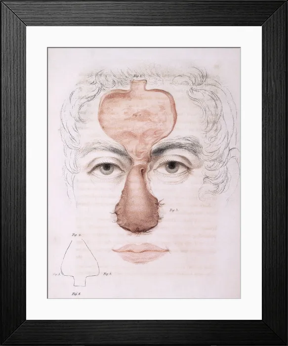 Framed Print : 19th Century Facial Reonstruction