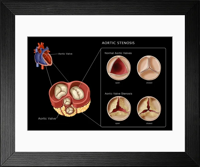Framed Print : Aortic Valves, Normal & Stenosis, Illustration
