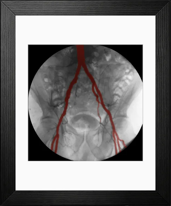 Framed Print : Angiogram of Iliac Arteries