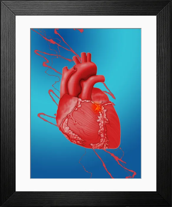 Framed Print : Heart Attack, Conceptual Illustration Framed Print : Heart Attack, Conceptual Illustration