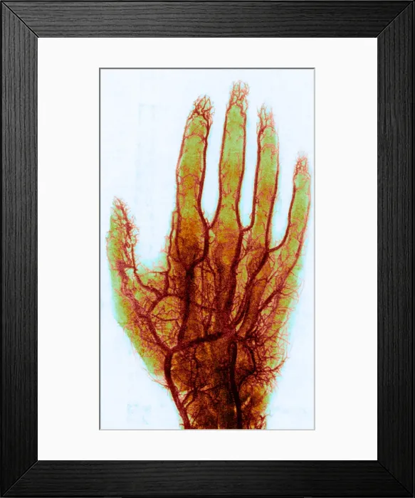 Framed Print : X-ray of Blood Vessels