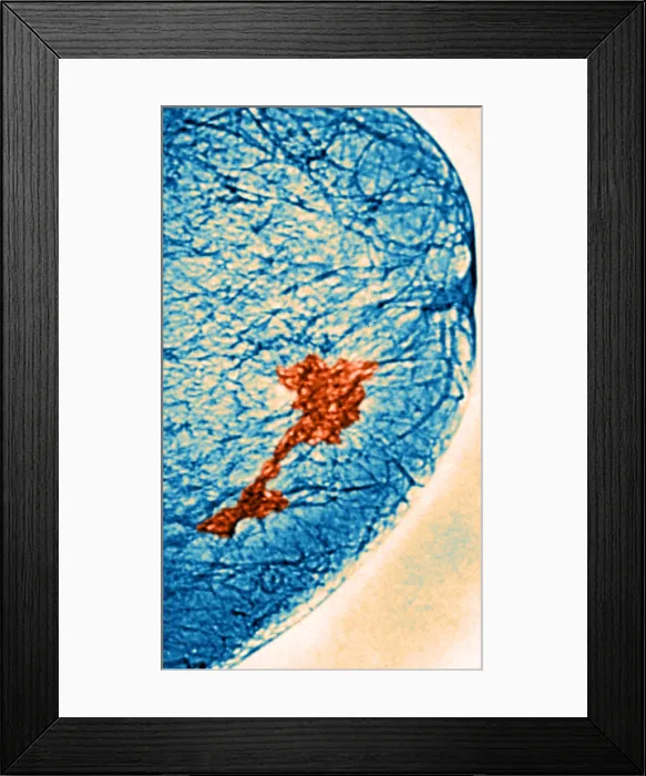 Framed Print : Mammogram. Color enhanced mammogram showing tumors in the breast tissue Framed Print : Mammogram. Color enhanced mammogram showing tumors in the breast tissue