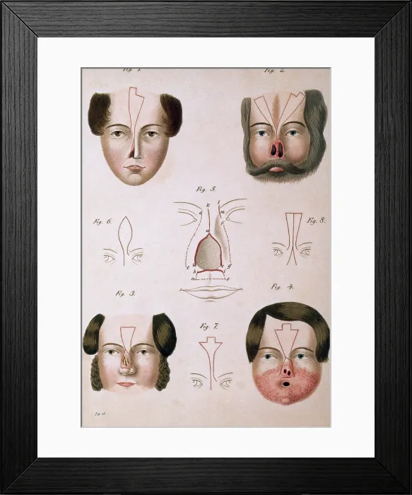 Framed Print : 19th Century Facial Reconstruction Framed Print : 19th Century Facial Reconstruction