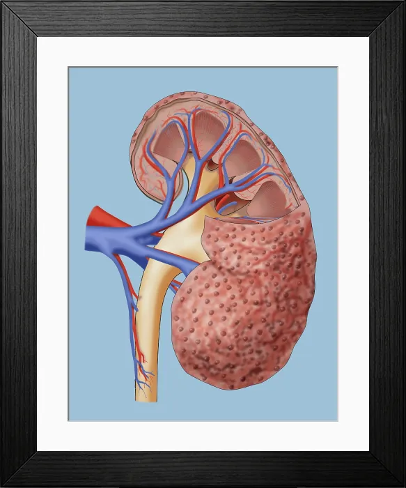 Framed Print : Chronic Kidney Disease, Illustration Framed Print : Chronic Kidney Disease, Illustration