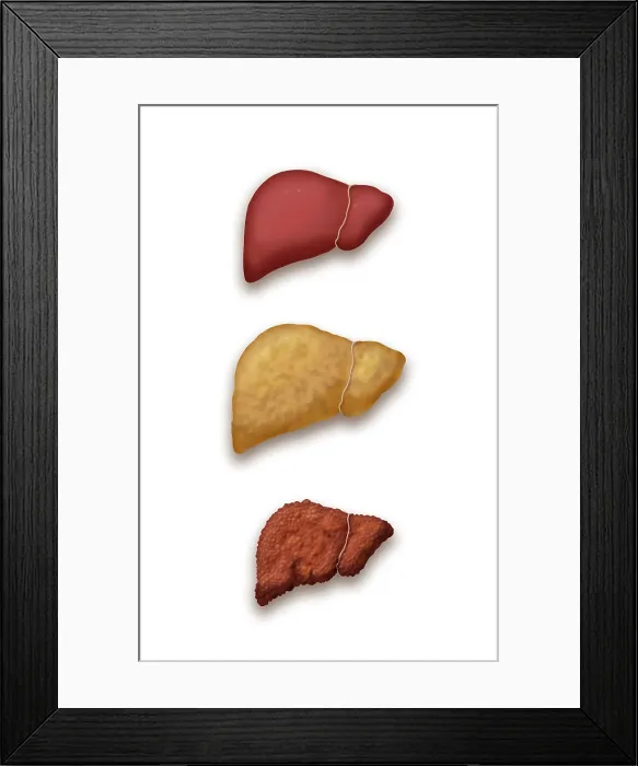 Framed Print : Liver Disease Progression, Illustration Framed Print : Liver Disease Progression, Illustration
