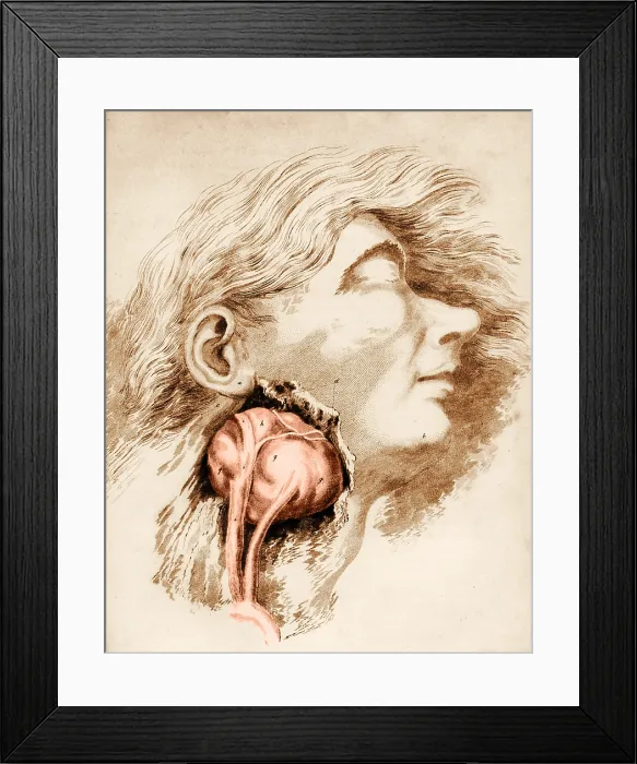 Framed Print : Aneurysm of the Carotid Artery