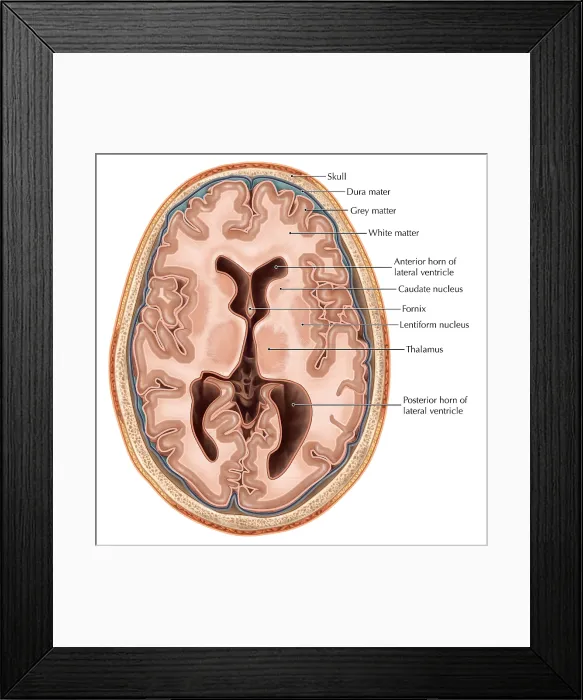 Framed Print : Transverse Section of the Brain Framed Print : Transverse Section of the Brain