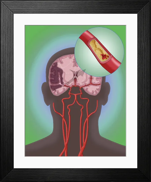 Framed Print : Ischemic Stroke, Illustration Framed Print : Ischemic Stroke, Illustration