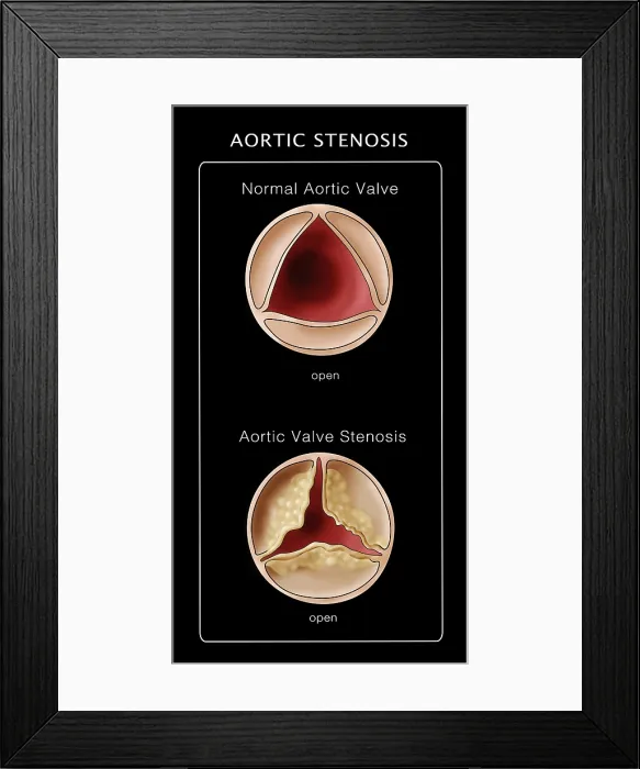 Framed Print : Aortic Valve, Normal & Stenosis, Illustration
