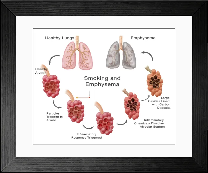 Framed Print : Lung Damage Leading to Emphysema Framed Print : Lung Damage Leading to Emphysema