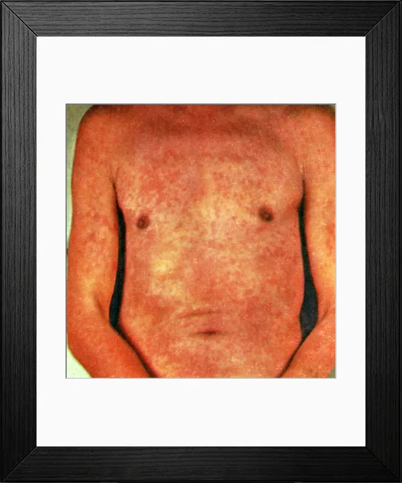 Framed Print : Miliaria (also known as miliaria rubra, sweat rash Framed Print : Miliaria (also known as miliaria rubra, sweat rash