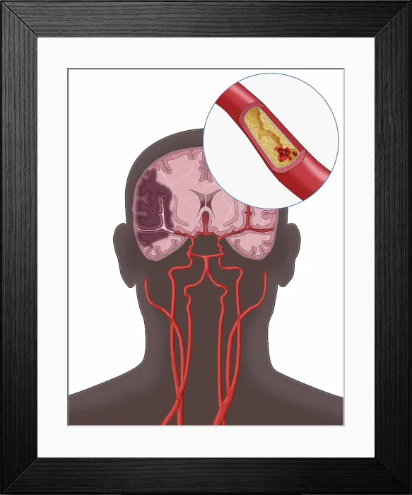 Framed Print : Ischemic Stroke, Illustration Framed Print : Ischemic Stroke, Illustration