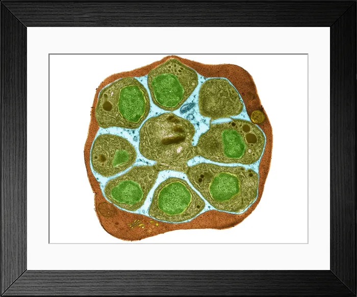Framed Print : red Blood Cell (RBC) Infected with Malarial Parasite, under a transmission electron microscope TEM Framed Print : red Blood Cell (RBC) Infected with Malarial Parasite, under a transmission electron microscope TEM