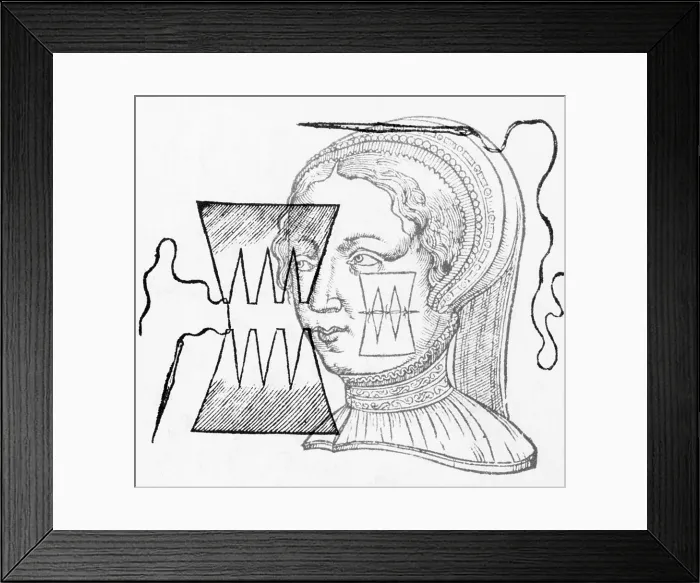 Framed Print : Pare Suture, 1500s Framed Print : Pare Suture, 1500s