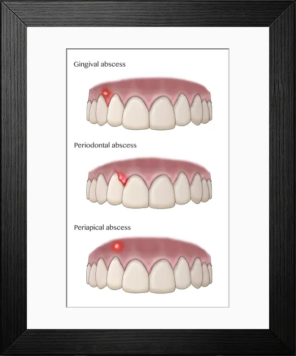 Framed Print : Types of Dental Abscesses, Illustration