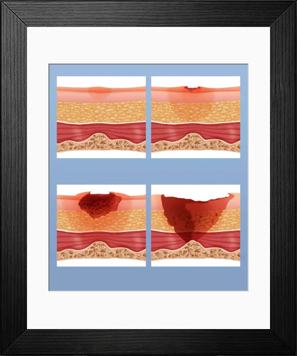 Framed Print : Bed Sores. Illustration showing the stages of of a bed sore or pressure ulcer Framed Print : Bed Sores. Illustration showing the stages of of a bed sore or pressure ulcer