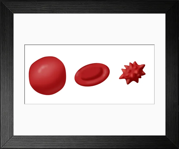 Framed Print : Osmotic Pressure on Blood Cells Framed Print : Osmotic Pressure on Blood Cells