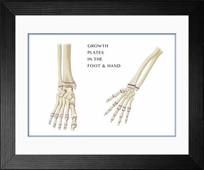 Framed Print : Growth Plates, Foot and Hand, Illustration Framed Print : Growth Plates, Foot and Hand, Illustration