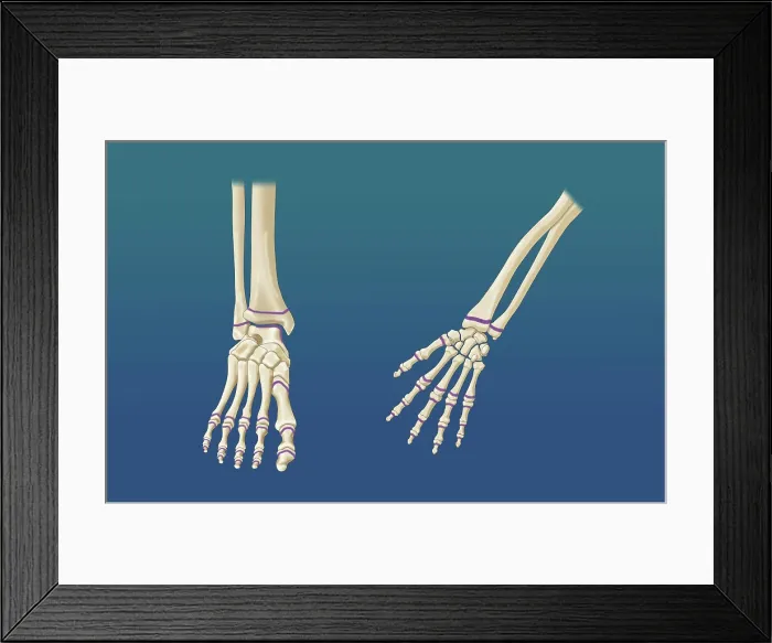 Framed Print : Foot and Hand Growth Plates, Illustration Framed Print : Foot and Hand Growth Plates, Illustration