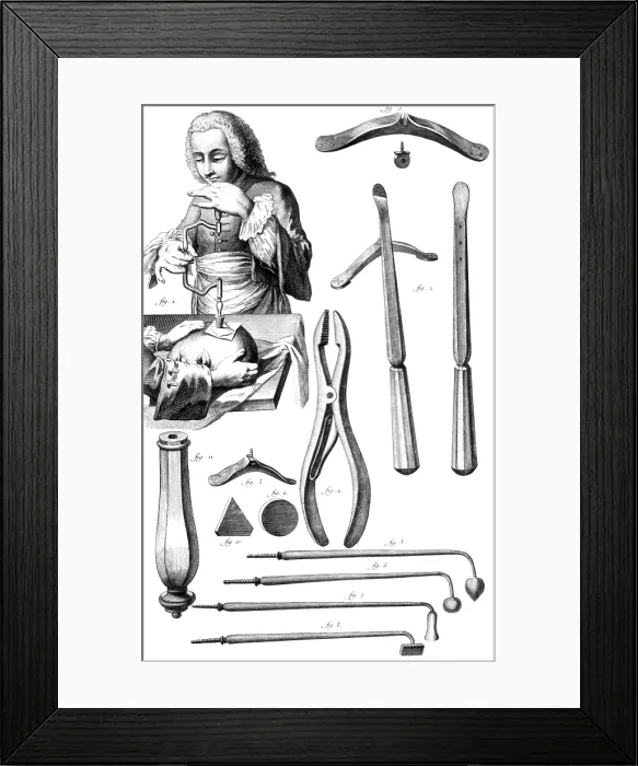 Framed Print : Trepanning, 1772 Framed Print : Trepanning, 1772