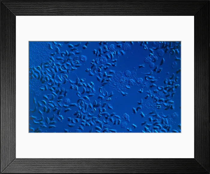Framed Print : SCD, Sickle-Cell Anemia, light micrograph Framed Print : SCD, Sickle-Cell Anemia, light micrograph