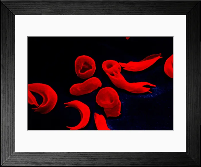 Framed Print : SCD, Sickle-Cell Anemia Disease, Normal and Sickle Shaped Blood Cells under a Scanning Electron microscope (SEM) Framed Print : SCD, Sickle-Cell Anemia Disease, Normal and Sickle Shaped Blood Cells under a Scanning Electron microscope (SEM)