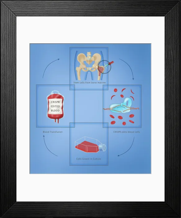 Framed Print : Diagram of CRISPR gene therapy as a Sickle Cell Anemia Disease cure through a transfusion, bone marrow aspiration, medical illustration Framed Print : Diagram of CRISPR gene therapy as a Sickle Cell Anemia Disease cure through a transfusion, bone marrow aspiration, medical illustration